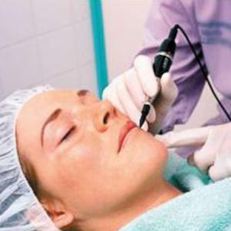 laser resurfacing procedure