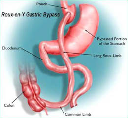 roux-en-y gastric bypass